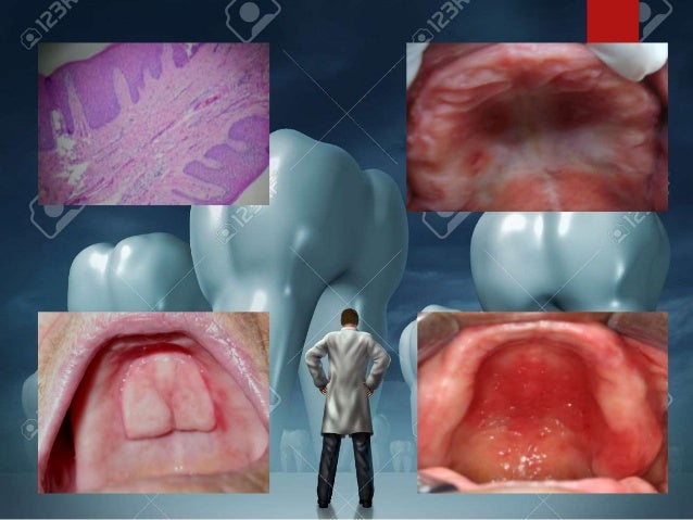 hiperplasia papilar inflamatoria